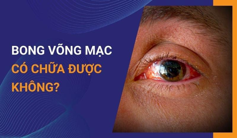 Các bệnh về mắt liên quan đến Retinal