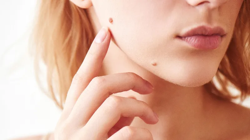 Kem tẩy nốt ruồi loại nào tốt?