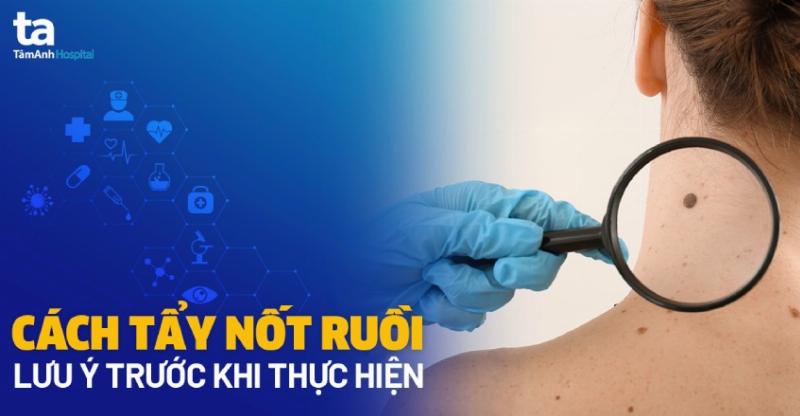 Kem tẩy nốt ruồi - lựa chọn thông minh?