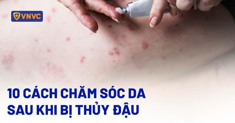 Mẹo chăm sóc da bị mụn nước