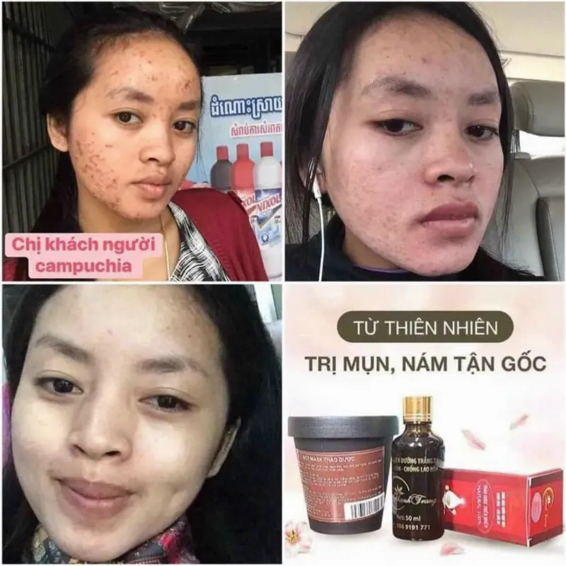 Thuốc bắc tái tạo da: Kết quả