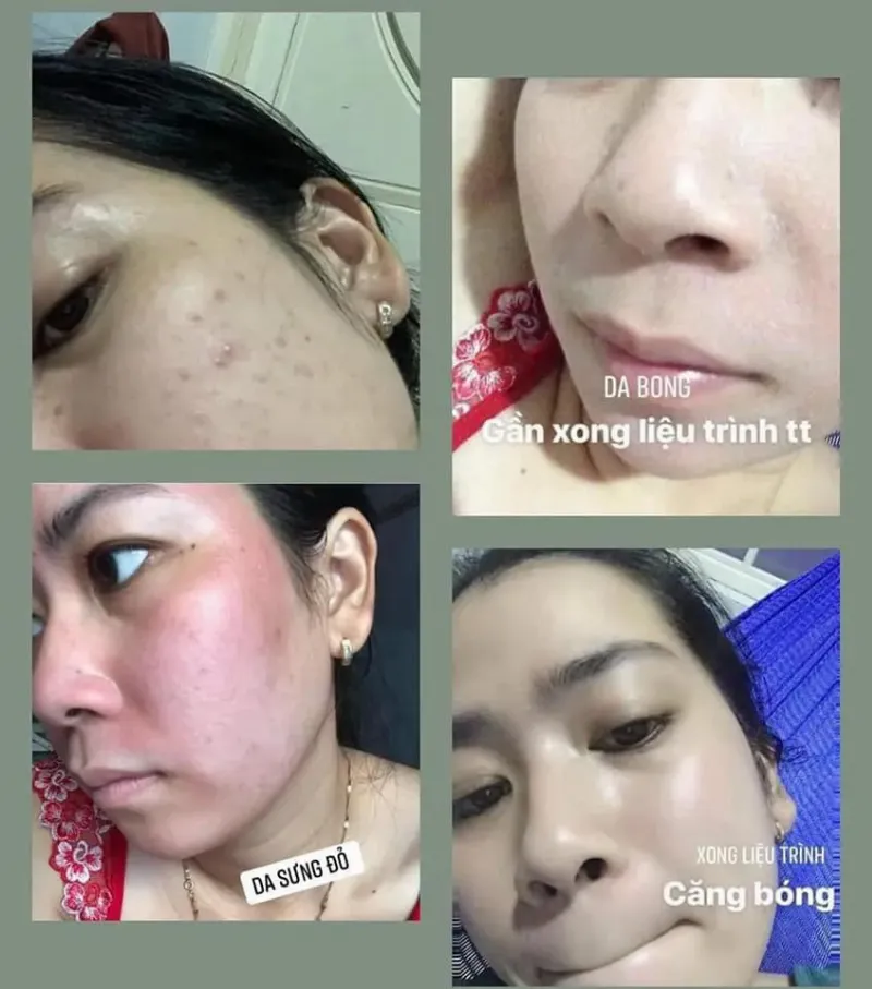 Thuốc bắc tái tạo da: Quy trình