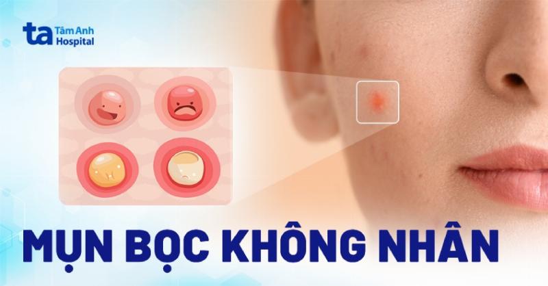 Các loại mụn viêm thường gặp như mụn bọc, mụn mủ, mụn nang cần được chấm mụn đúng cách để giảm sưng đỏ và nhanh lành