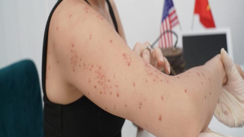 Hình ảnh mô tả các bước chuẩn bị trước khi bôi thuốc Bacterocin Oint 15g (rửa tay, làm sạch vùng da)