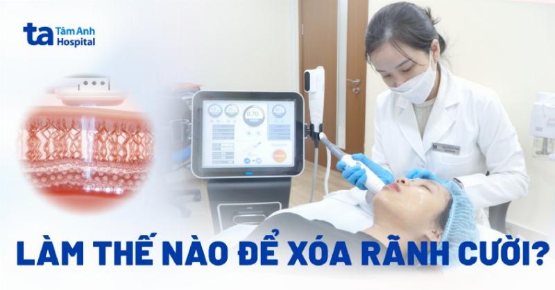 Hình ảnh minh họa hiệu quả của filler Hàn Quốc làm đầy rãnh mũi má
