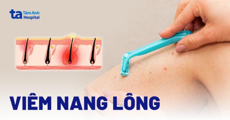 Nhận biết khi nào mụn viêm cần sự can thiệp của bác sĩ da liễu để có hướng điều trị phù hợp và kịp thời