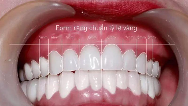 Hình ảnh một người đang cười tươi, thể hiện sự tự tin với hàm răng trắng sáng.