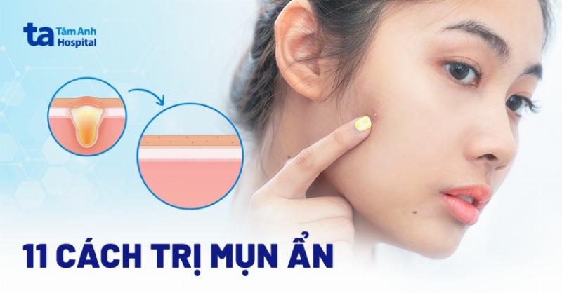 Quy trình 5 bước chấm mụn viêm chuẩn xác từ làm sạch đến dưỡng ẩm giúp trị mụn hiệu quả và an toàn cho da