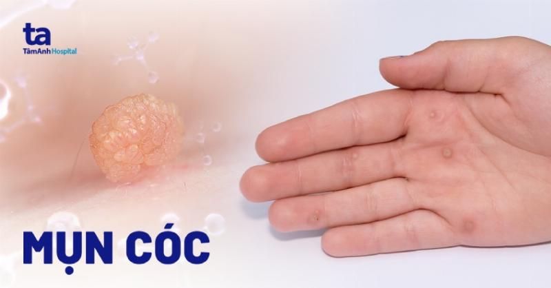 Hình ảnh minh họa sự khác biệt giữa thâm mụn và sẹo mụn, và huyết thanh trị mụn có thể giúp gì