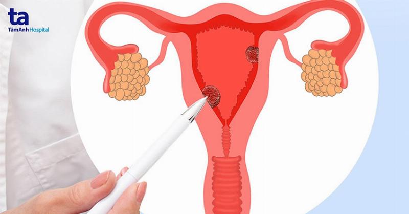 Các yếu tố chính ảnh hưởng đến kích thước vòng 1 như di truyền, hormone, và cân nặng được minh họa